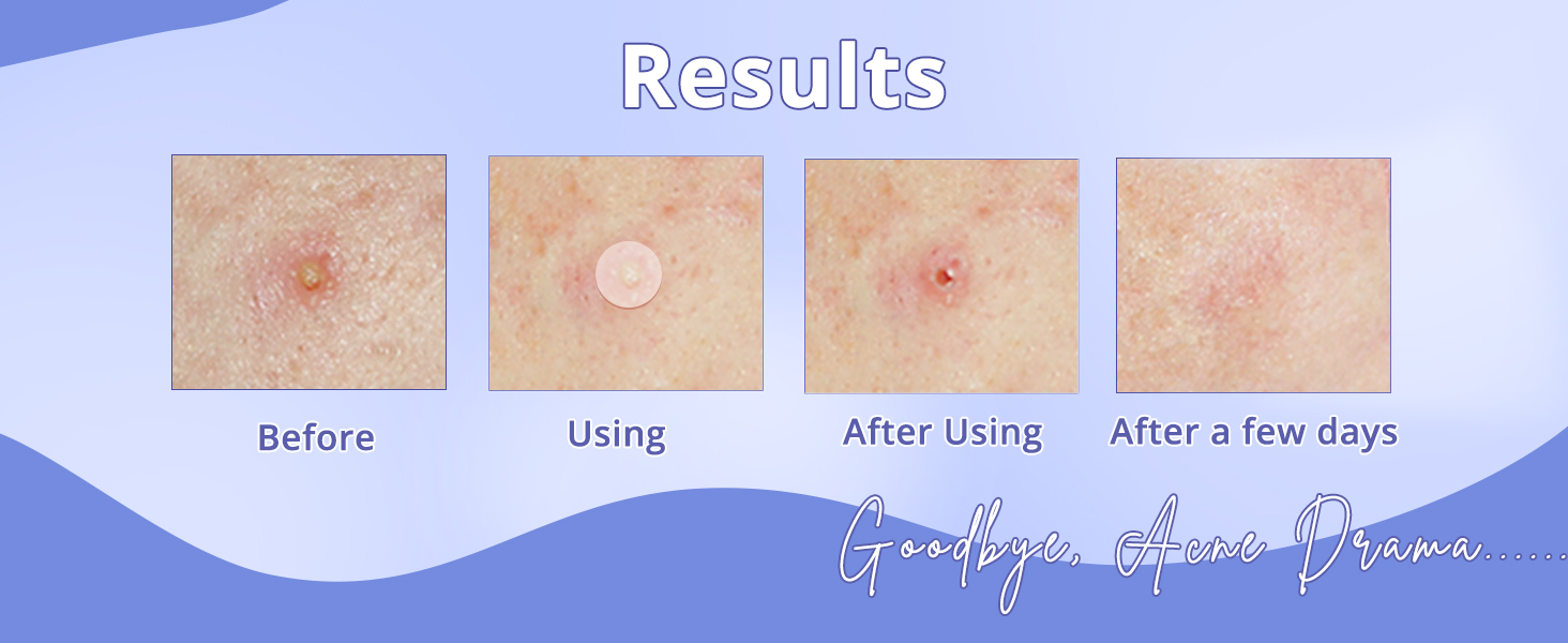 Erazer Acne Pimple Patches